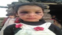 ضرب وحشي وتعذيب بالنار.. يوميات من الجحيم تعايشها الطفلة "شيماء" مع والدها الحوثي وزوجته ضرب وحشي وتعذيب بالنار.. يوميات من الجحيم تعايشها الطفلة "شيماء" مع والدها الحوثي وزوجته